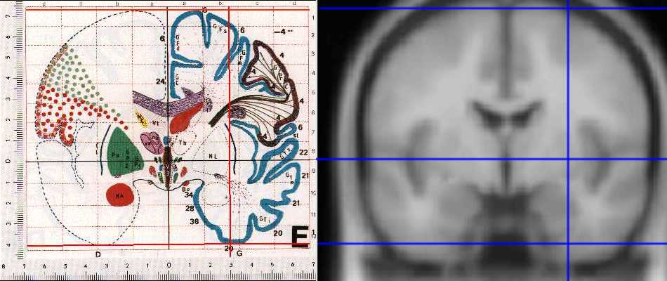 http://imaging.mrc-cbu.cam.ac.uk/images/mnitalcor.jpg